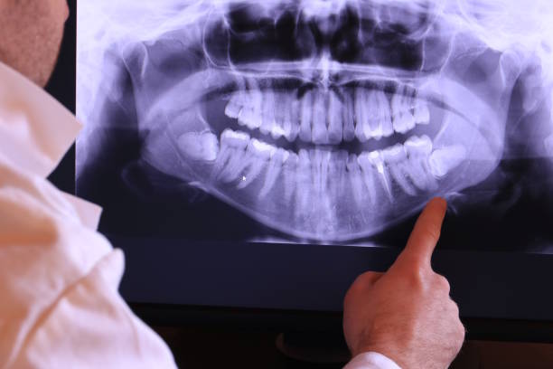 Best Emergency Wisdom Teeth Removal in Aberdeen, IN